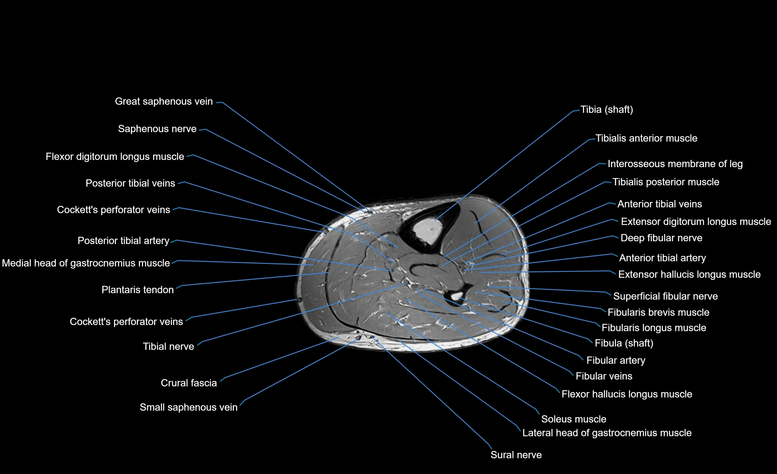 MRI lower leg axial cross sectional anatomy 3T  radiology  image-img-00001-00051.webp